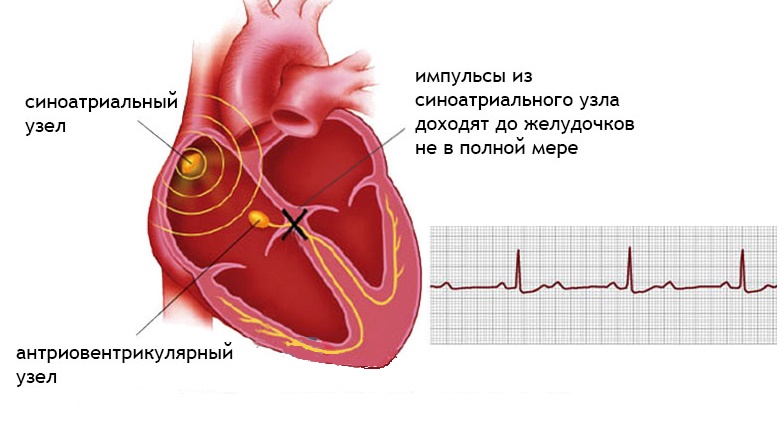 Блокада болезнь. Блокада проводимости сердца. Блокада проводящей системы сердца ЭКГ. Атриовентрикулярной блокадой сердца. Проводящая система сердца при АВ блокаде.