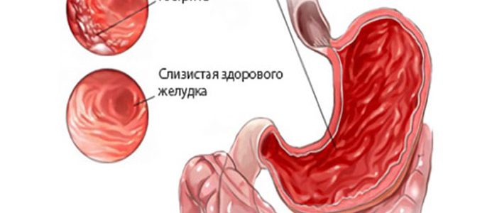 Может ли желудок влиять на артериальное давление thumbnail