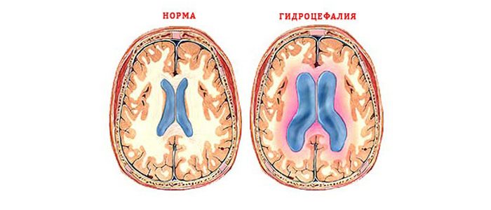 Синдром повышения внутричерепного давления и гидроцефалии thumbnail