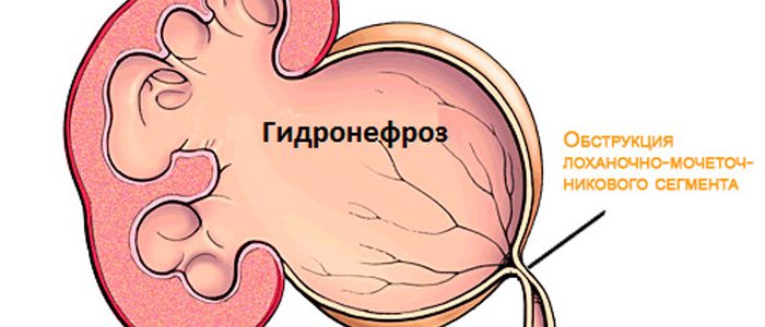Гипертония и гидронефроз лечение thumbnail