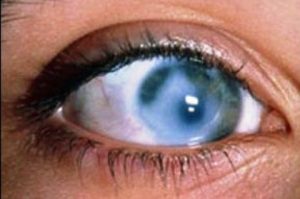 Может ли глаз болеть от давления глазного thumbnail
