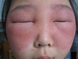 Может ли быть повышенное давление от аллергии thumbnail
