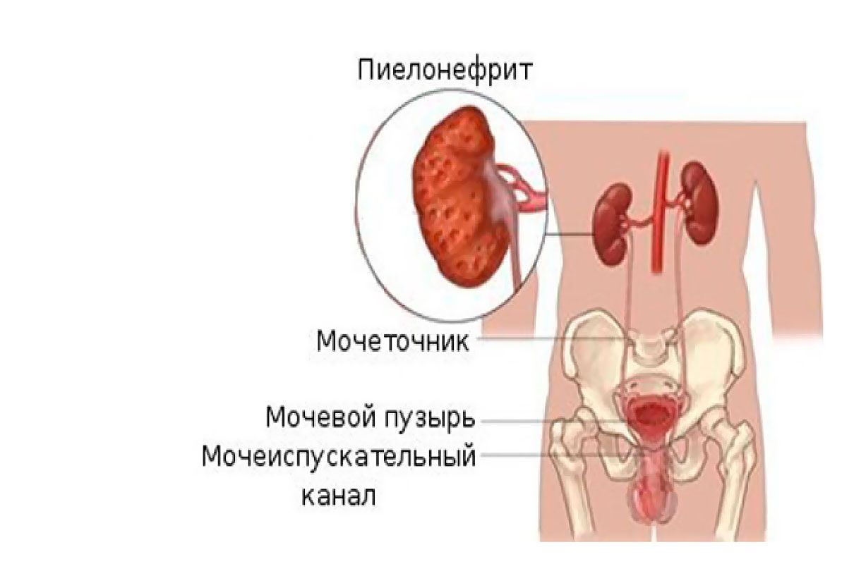 Воспаление почки симптомы и лечение у мужчин. Хронический пиелонефрит почек.