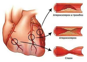 Артериальная гипертензия причина инфаркта thumbnail