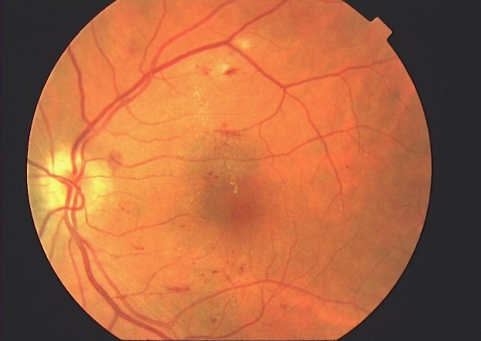 Воспаление сетчатки. Гипертоническая ангиопатия и ретинопатия. Геморрагическая ретинопатия. Гипертоническая ретинопатия глазное дно. Вальсальва ретинопатия.