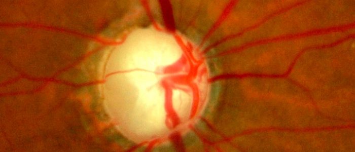 Атрофия зрительного нерва глаукома thumbnail