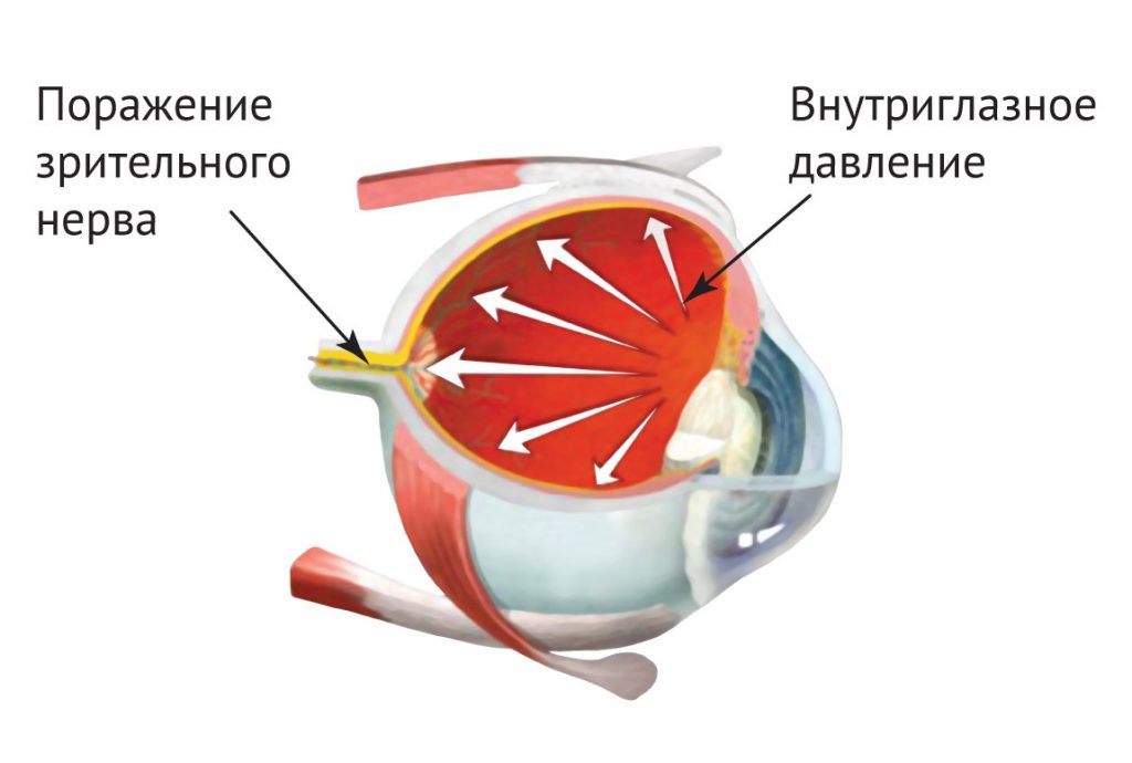 Как видит человек с глаукомой картинки