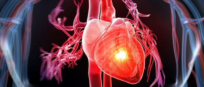 Симптомы при ишемической болезни сердца и гипертония thumbnail