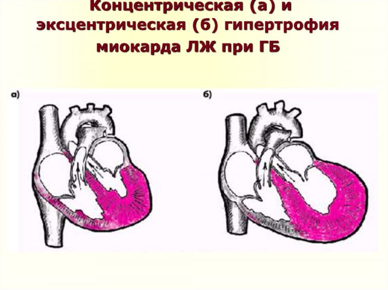 Левый желудочек сердца фото