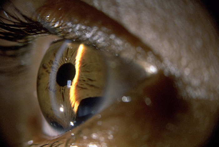 Давление в глазах симптомы. Закрытоугольная глаукома. Открытоугольная глаукома фото. Открытоугольная глаукома и катаракта.
